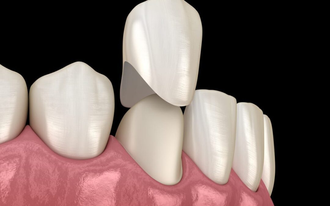 Easy Tips for Taking Care of Your Dental Crowns